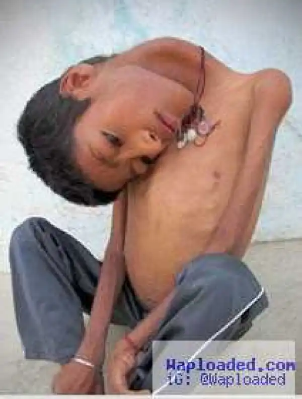 Boy whose head hung upside down undergoes surgery